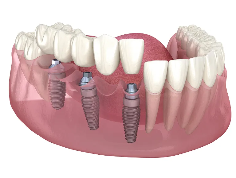 Benefits of Multiple Tooth Implants