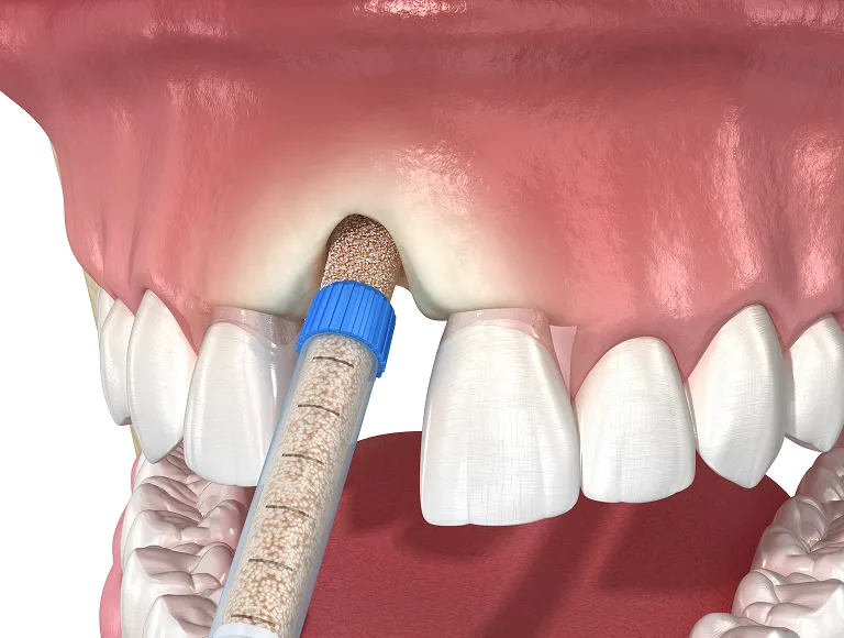 Sedation Dentistry in Costa Mesa, CA