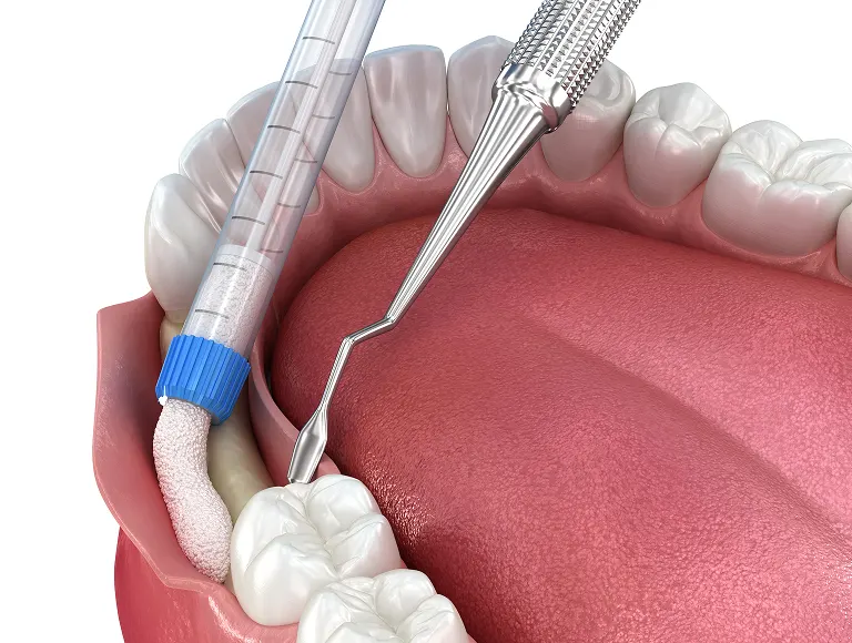 What Is Bone Grafting?