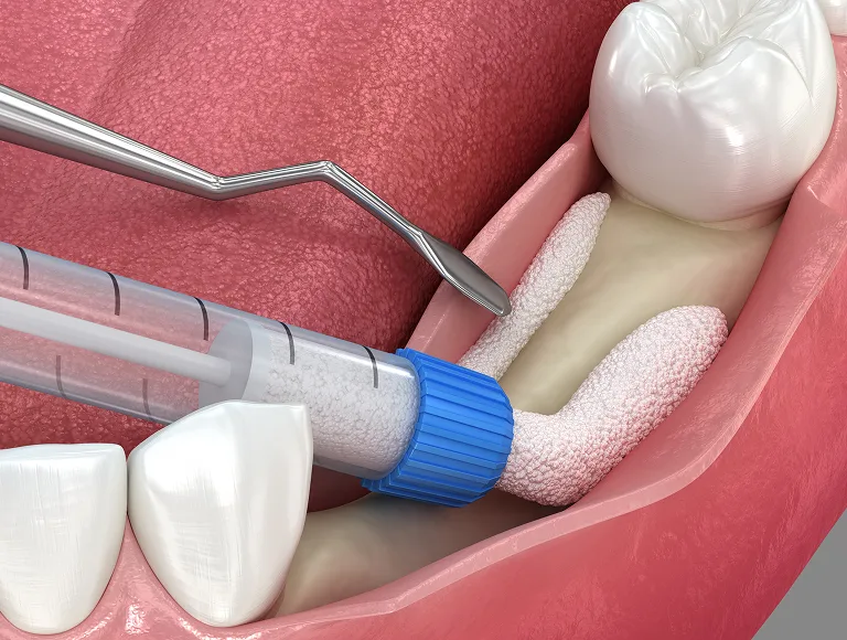 Who Is a Candidate for Bone Grafting?