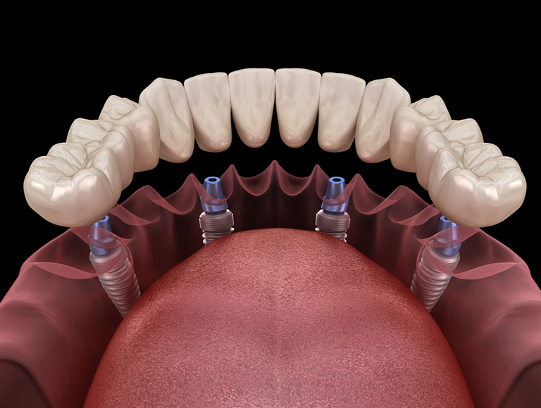 What Are Full-Arch Implants?