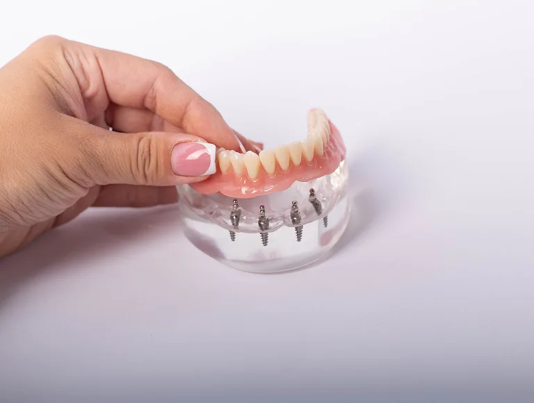 How Implant-Supported Dentures Work