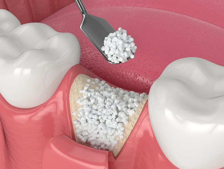 Do I Need Bone Grafting?