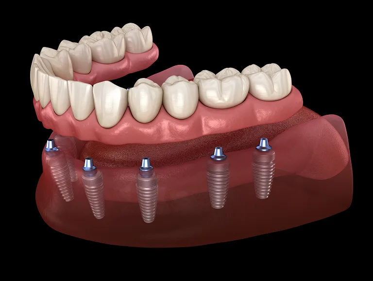 What Are Implant-Supported Dentures?
