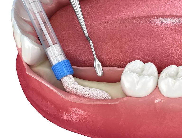 Bone Grafting and Preparatory Procedures