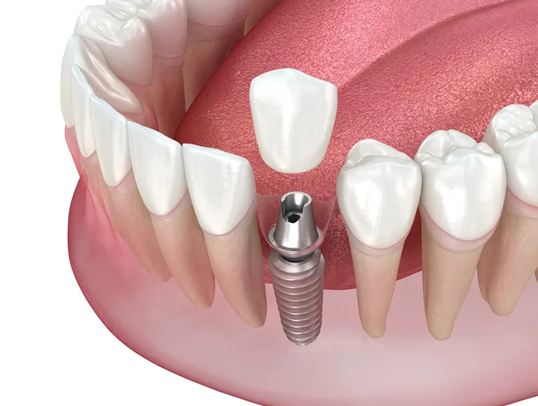 Why Choose a Single Tooth Implant?