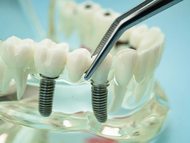 What Are Multiple Tooth Implants?
